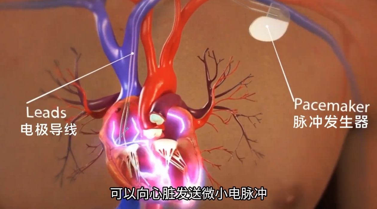 心臟起搏器